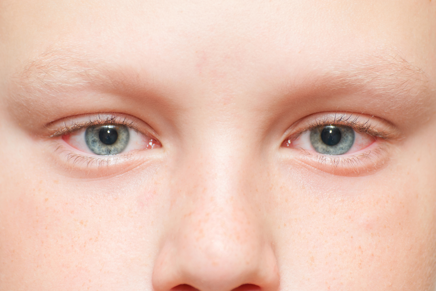 Из-за чего у ребенка гноятся глаза?
